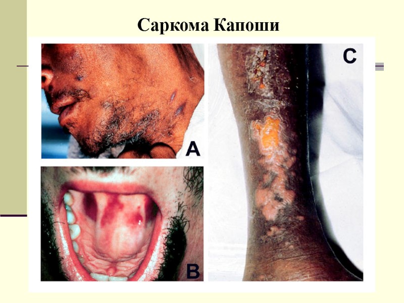 Саркома Капоши